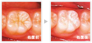 シーラントはフッ素の含まれている樹脂で、このすきまを歯を削ることなくつめる処置です。